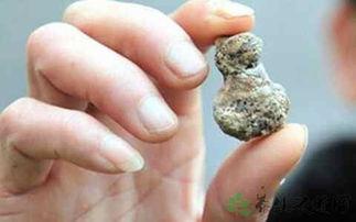 肾结石吃咸瓜,肾结石患者需谨慎